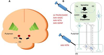 Perspective on the Road toward Gene Therapy for Parkinson’s Disease